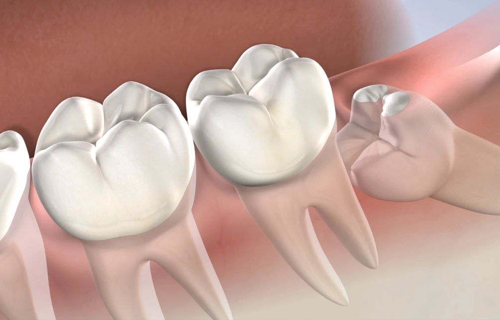 impacted wisdom teeth