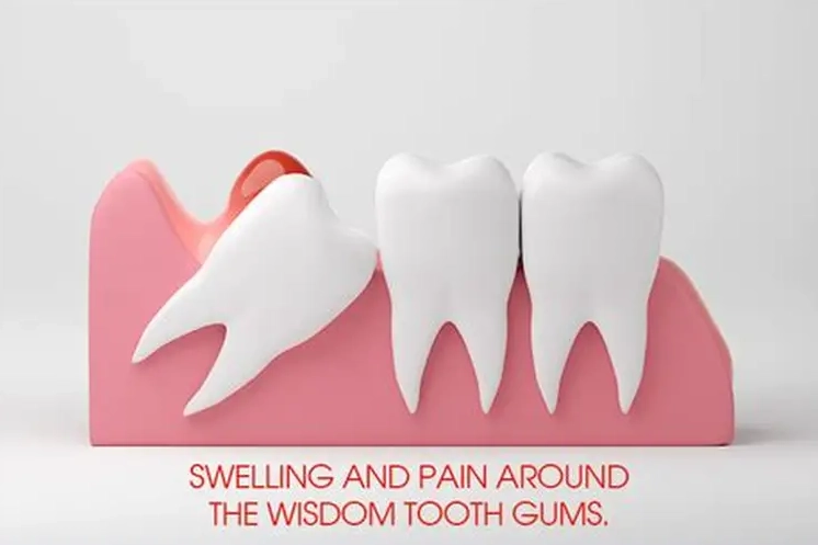wisdom tooth growing pain