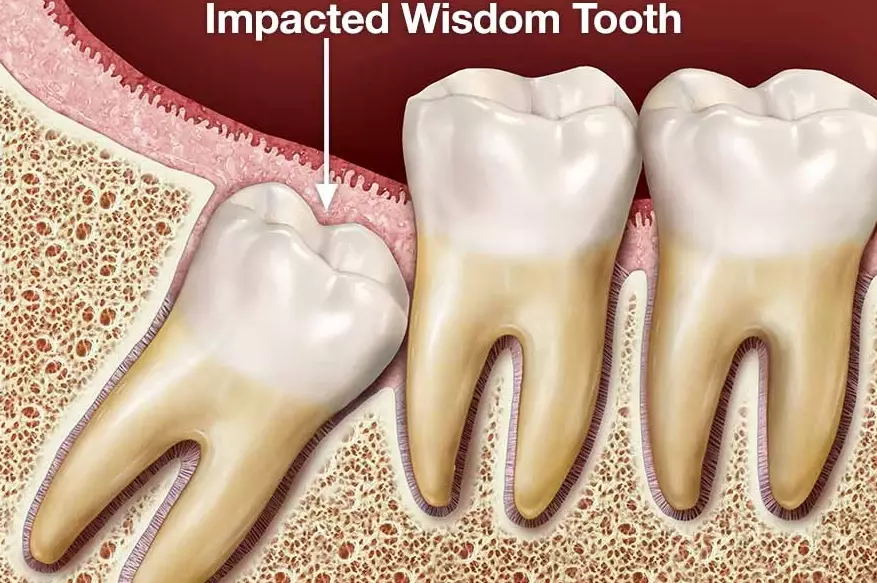 wisdom teeth pain relief