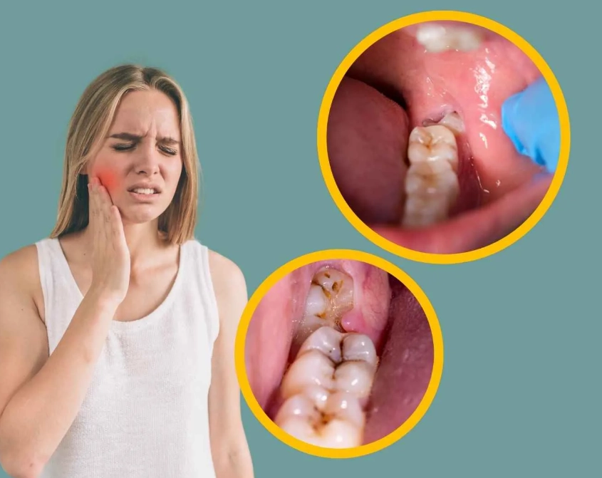 how to stop wisdom tooth pain
