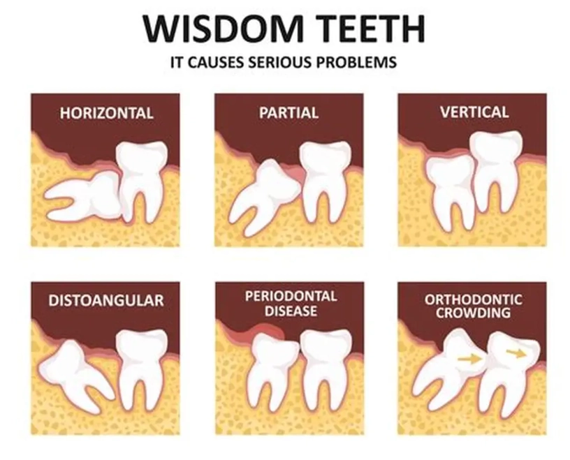 dentigerous cyst treatment