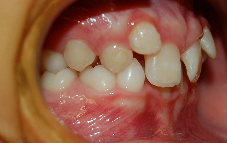 do wisdom teeth cause crowding