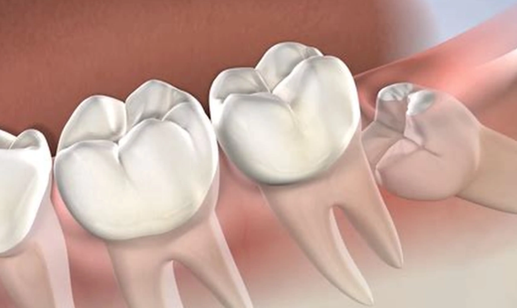 When to Remove Wisdom Teeth: The Complete Guide to Timing and Signs