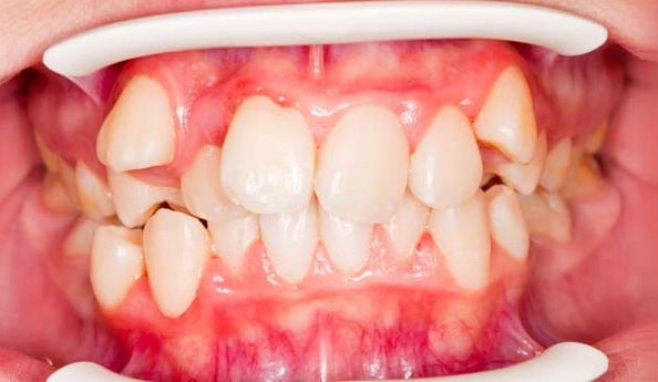 oil pulling for teeth