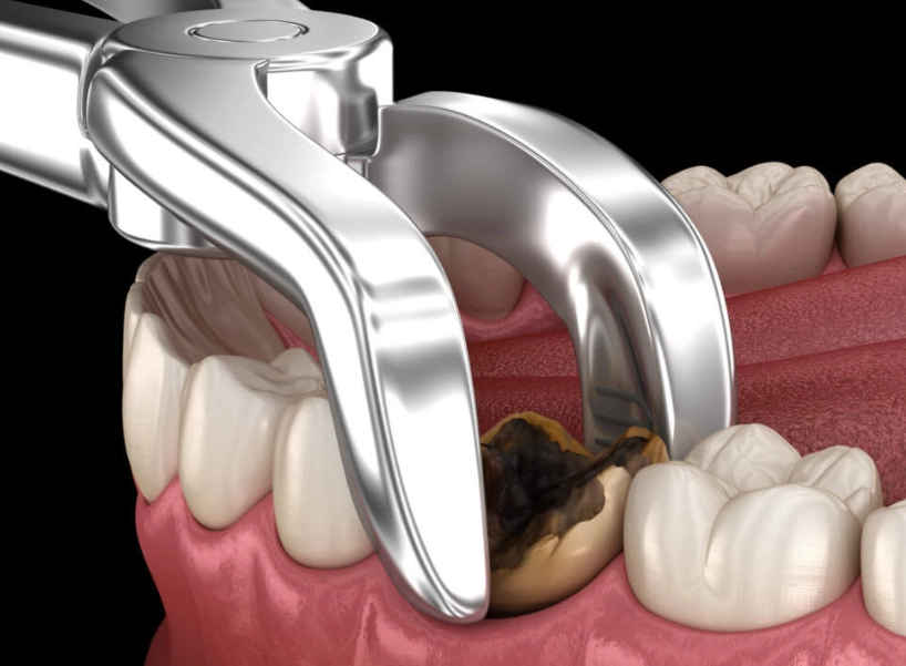 pulled tooth recovery