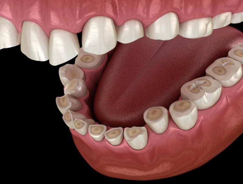 how to stop grinding teeth at night