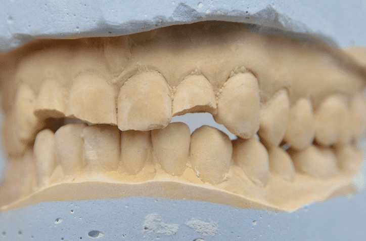 how to stop grinding teeth at night