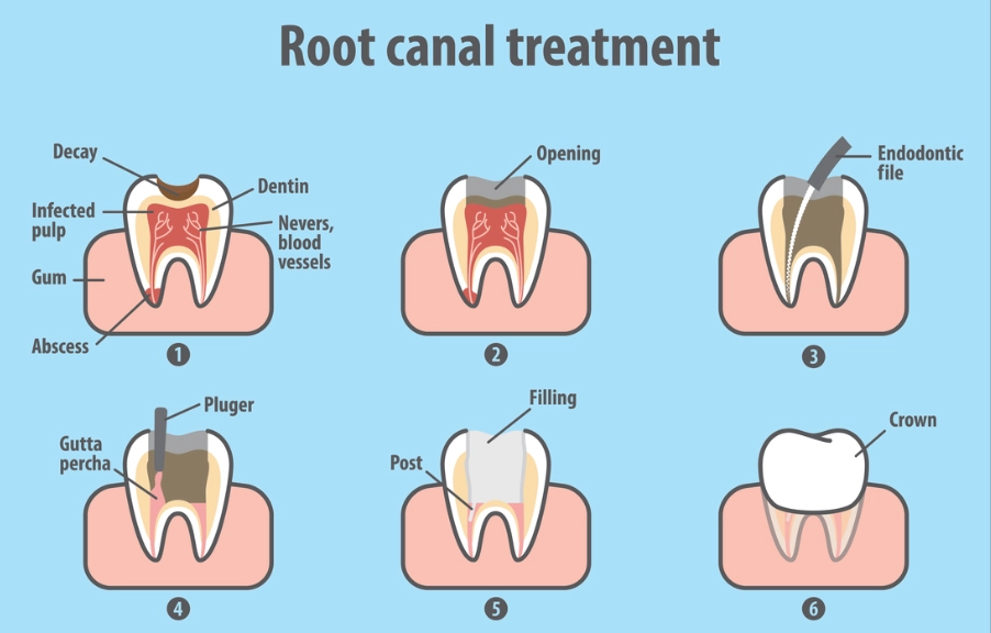 tooth discoloration after root canal