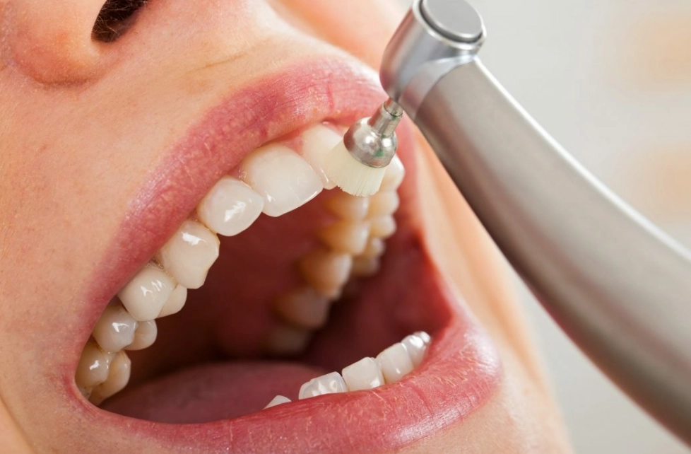 15 minute dental cleaning 15 minute dental cleaning