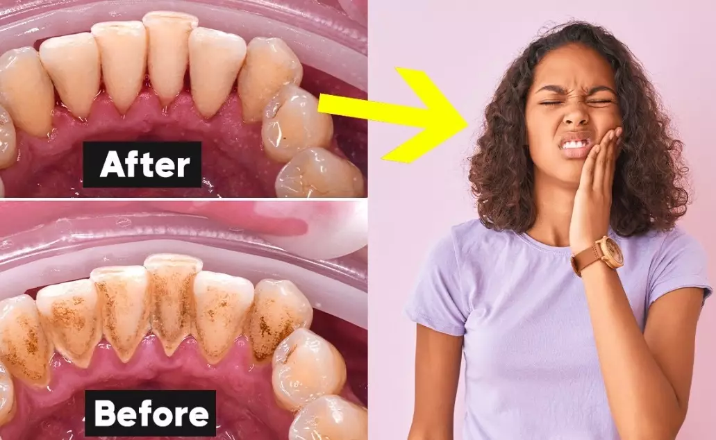 fast dental cleaning fast dental cleaning