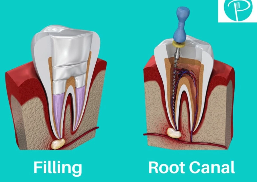 root canal crown color