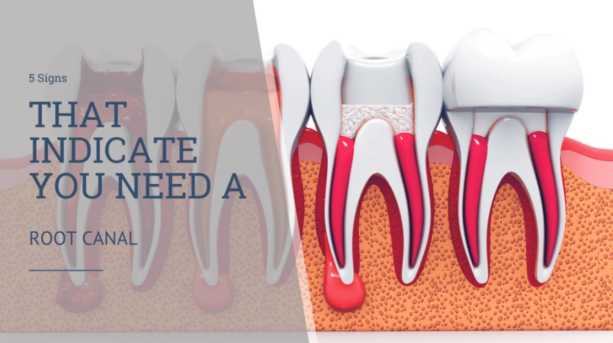 signs of root canal signs of root canal