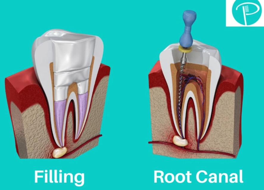 managing root canal pain
