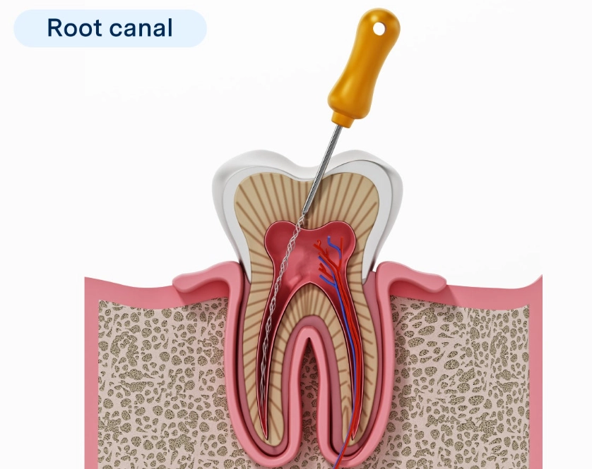 tooth after root canal tooth after root canal