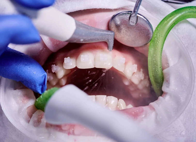 painful teeth cleaning painful teeth cleaning