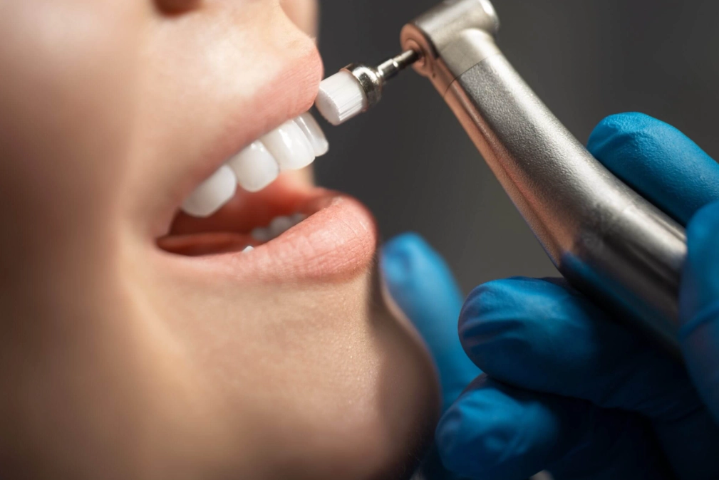 quick teeth cleaning quick teeth cleaning