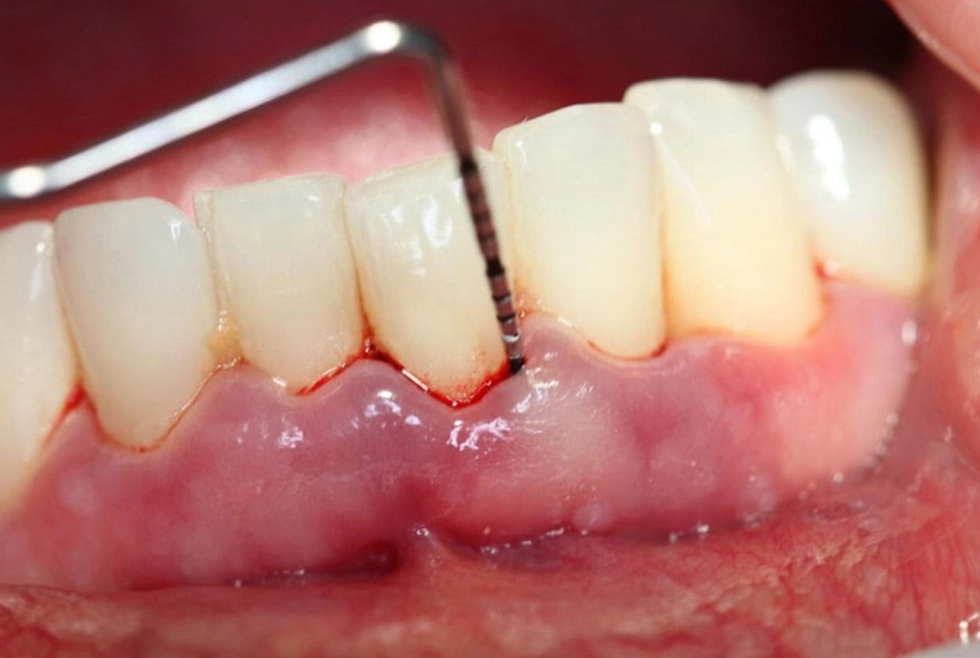 dental cleaning side effects