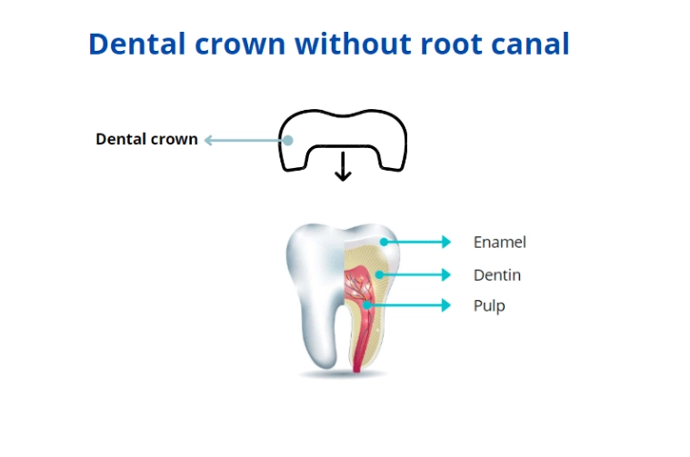 What does a root canal look like without a crown