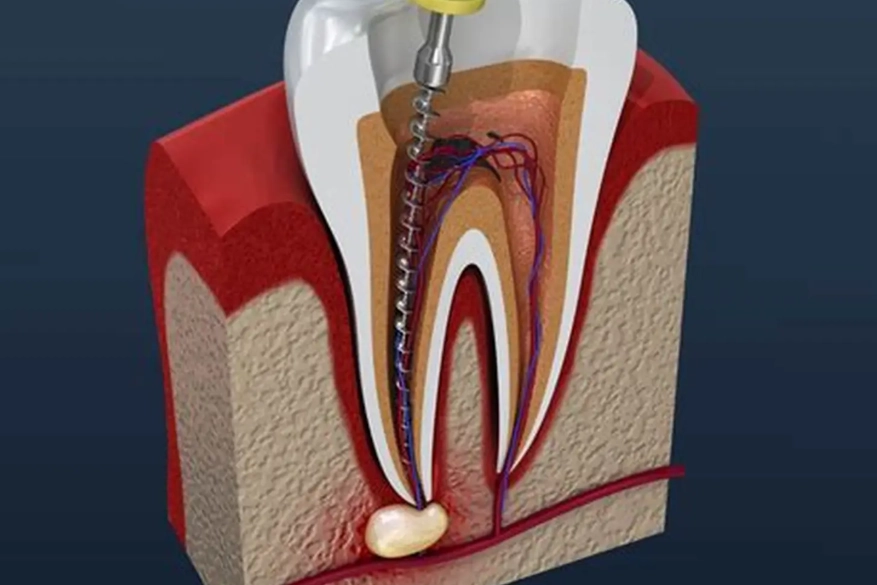 tooth discoloration after root canal