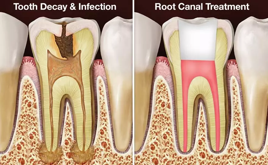Does your tooth look different after a root canal?