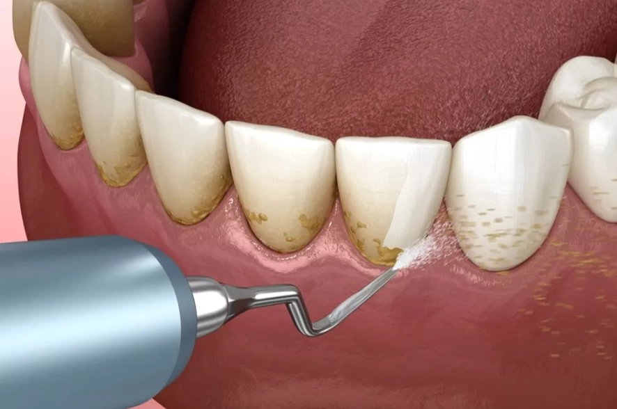 sensitive teeth cleaning sensitive teeth cleaning