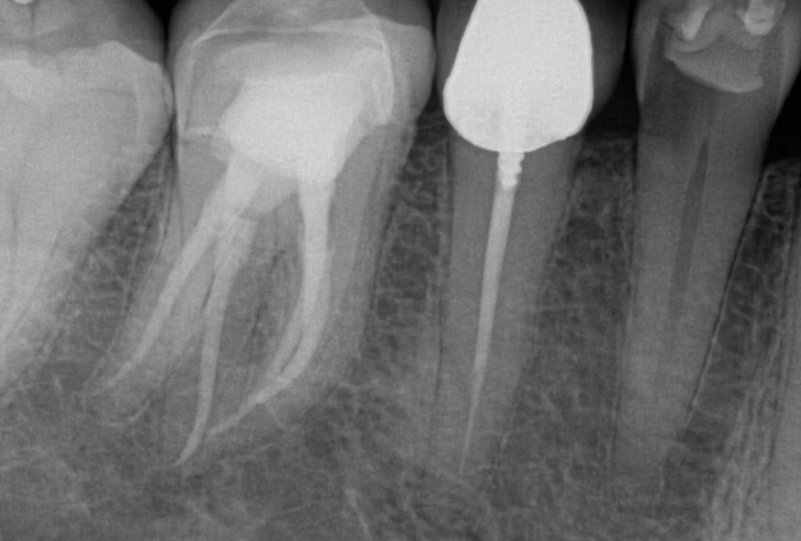 premolar root canal premolar root canal