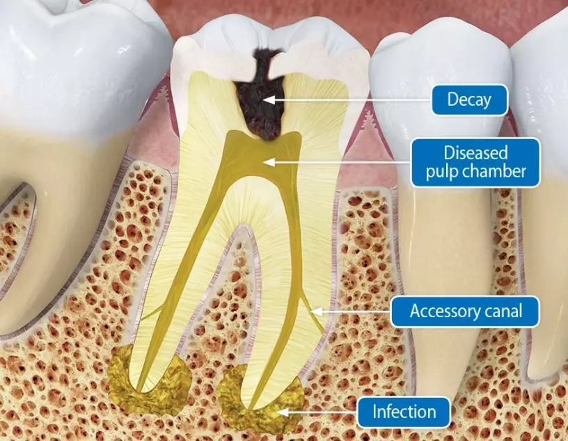 molar root canal procedure