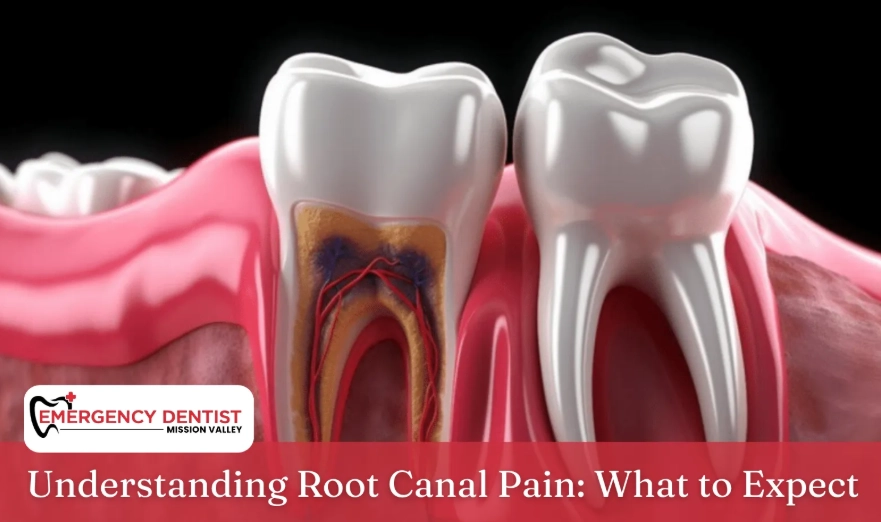 root canal pain
