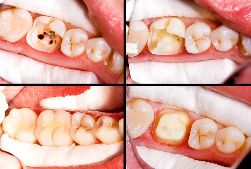 root canal procedure root canal procedure