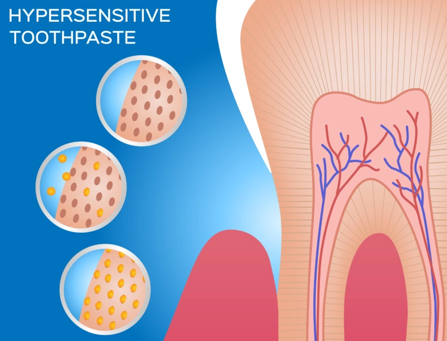 tooth sensitivity relief