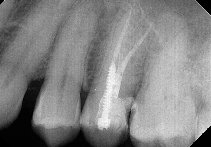 root canal procedure root canal procedure
