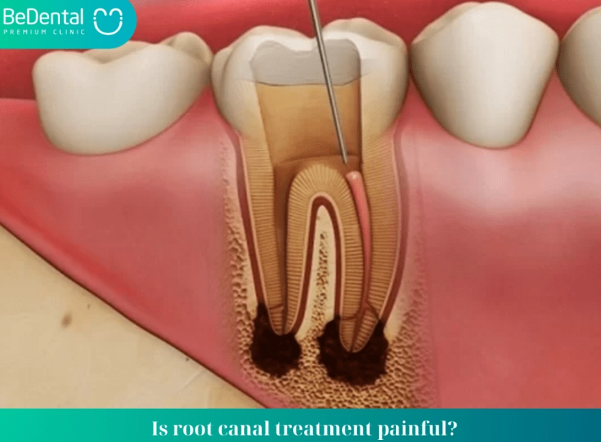 root canal procedure
