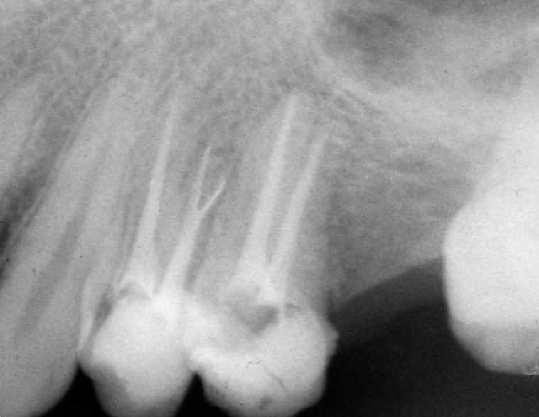 root canal cost root canal cost
