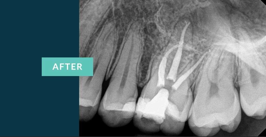 root canal cost root canal cost