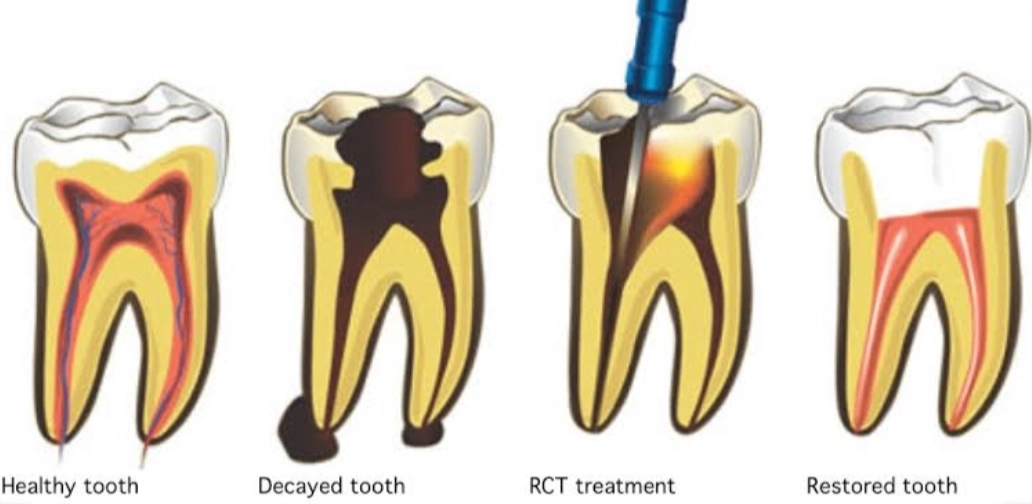 rct tooth