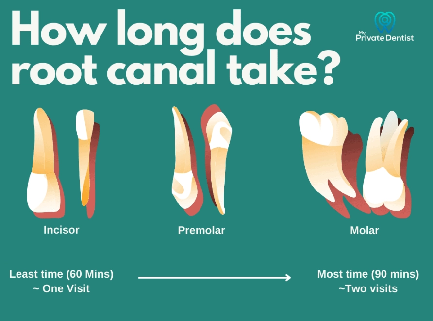 How long does a molar RCT take?