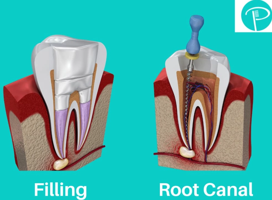 Can a root canal be done on a molar?