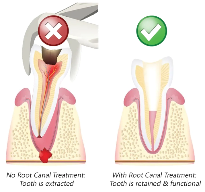 root canal molar