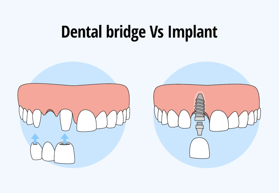 dental implant cost dental implant cost