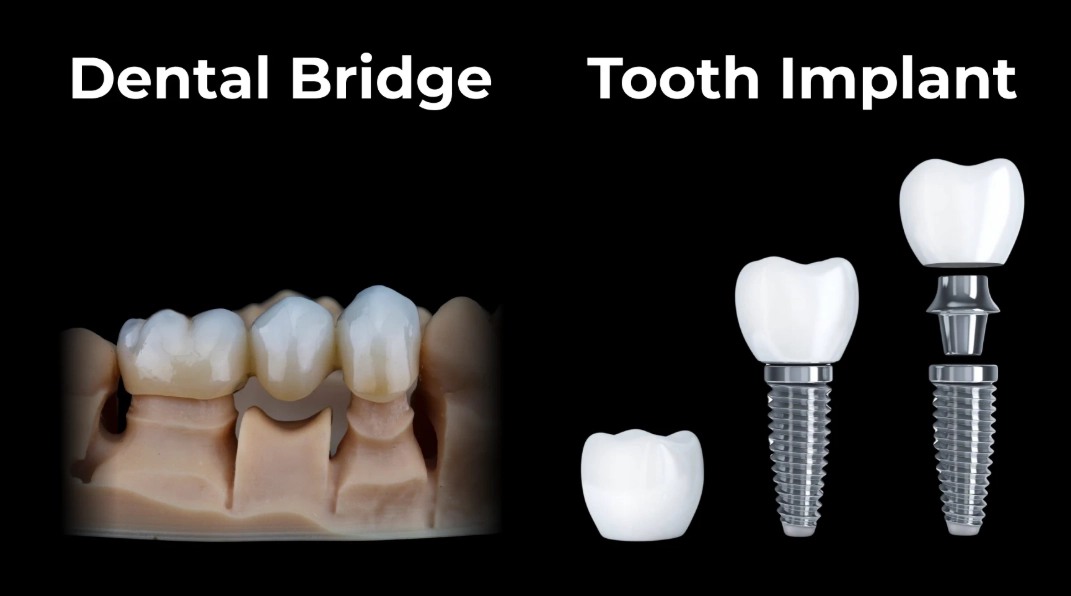 dental bridge cost dental bridge cost