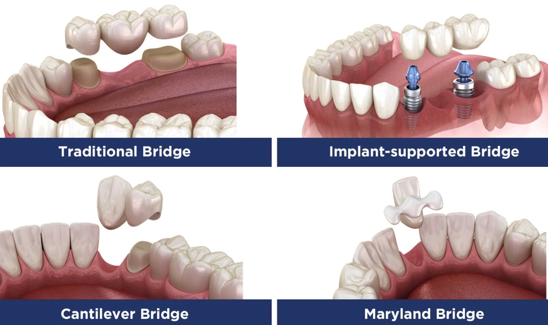 dental bridge cost
