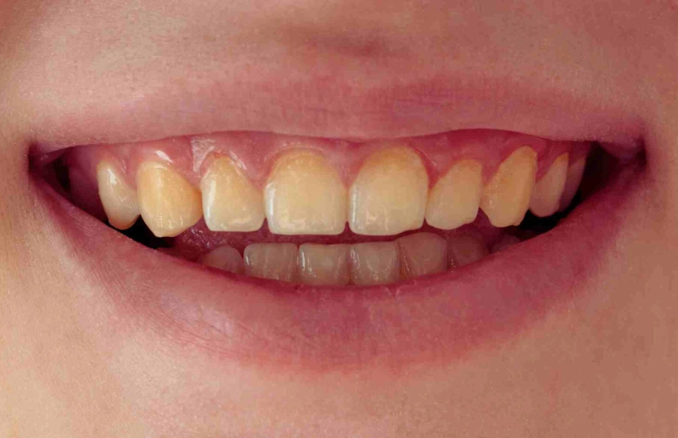 Why are my teeth still yellow after whitening strips?