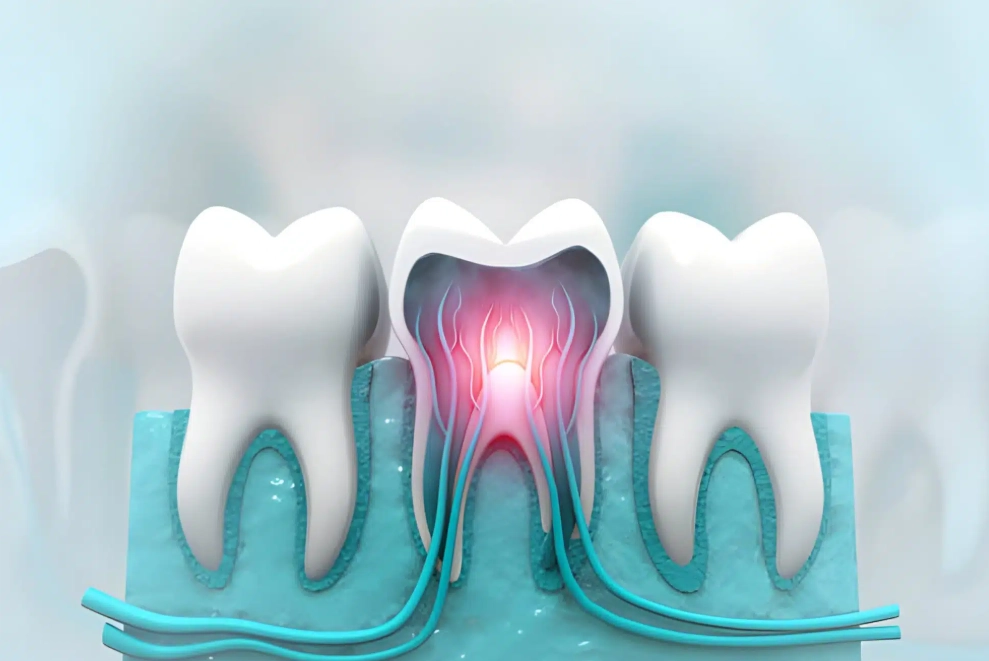 kill tooth nerve permanently