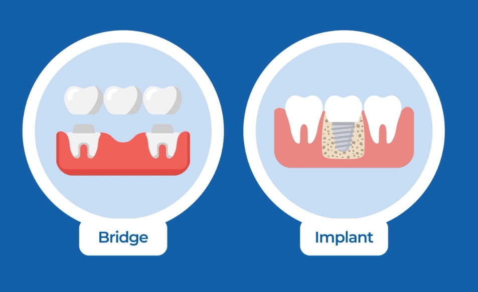 Is a bridge cheaper than an implant?