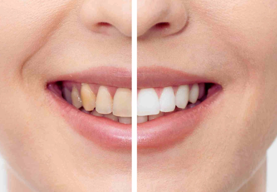 teeth still yellow after whitening strips