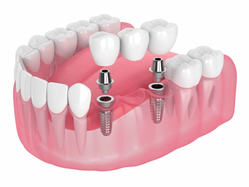dental implant cost dental implant cost