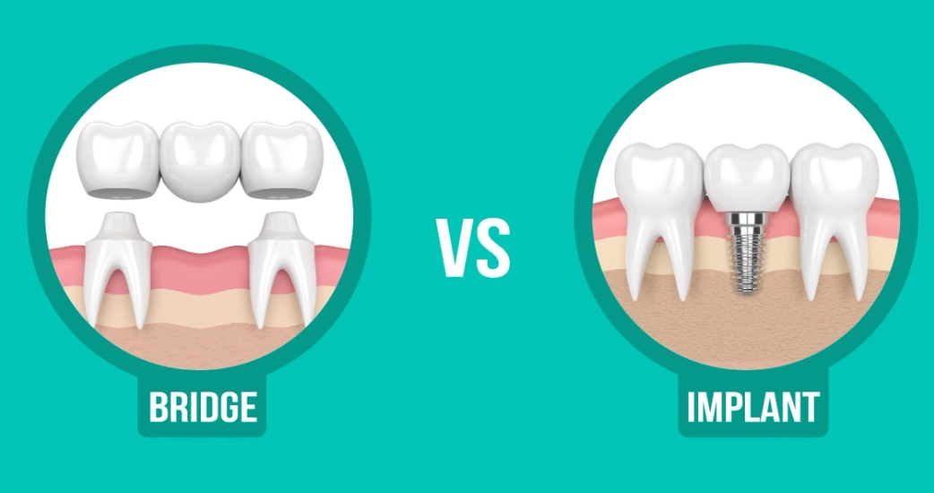 bridge vs implant bridge vs implant