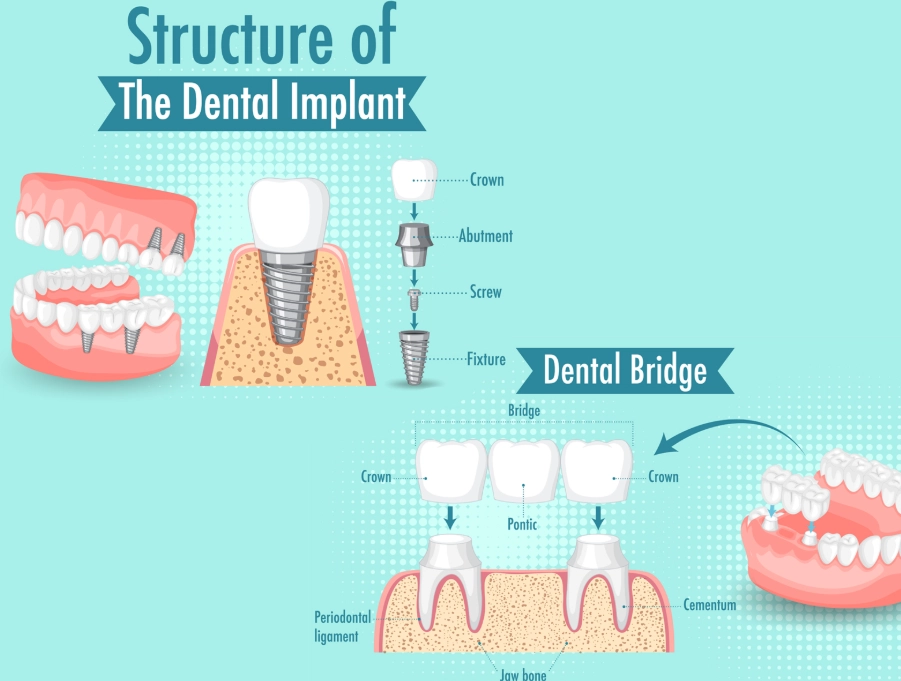 bridge vs implant bridge vs implant