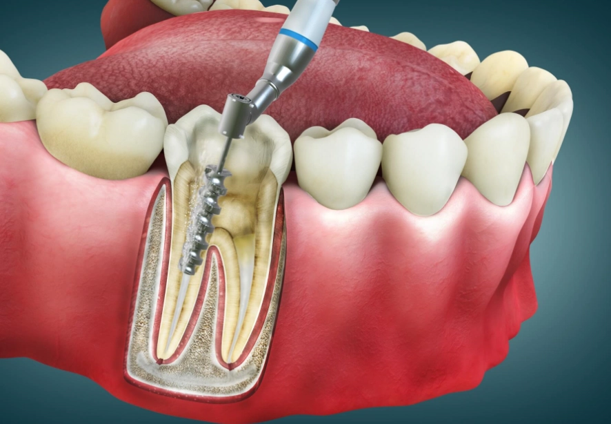 how long does a root canal take to heal