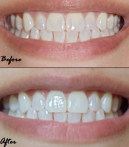 teeth whitening strips effectiveness